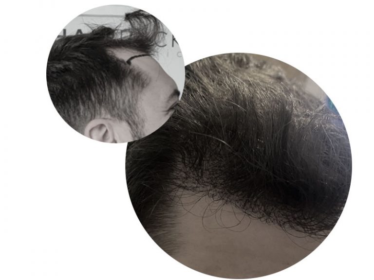 Greffe-cheveux-Baykal-DHI-Entrées