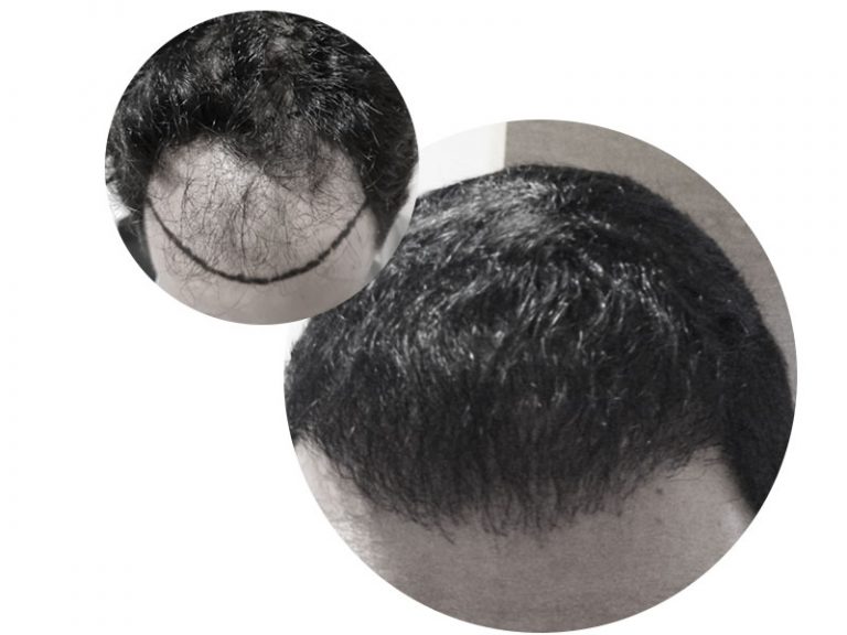 alopécie-Frontale-Dr-Baykal-Oymak-Greffe-Cheveux