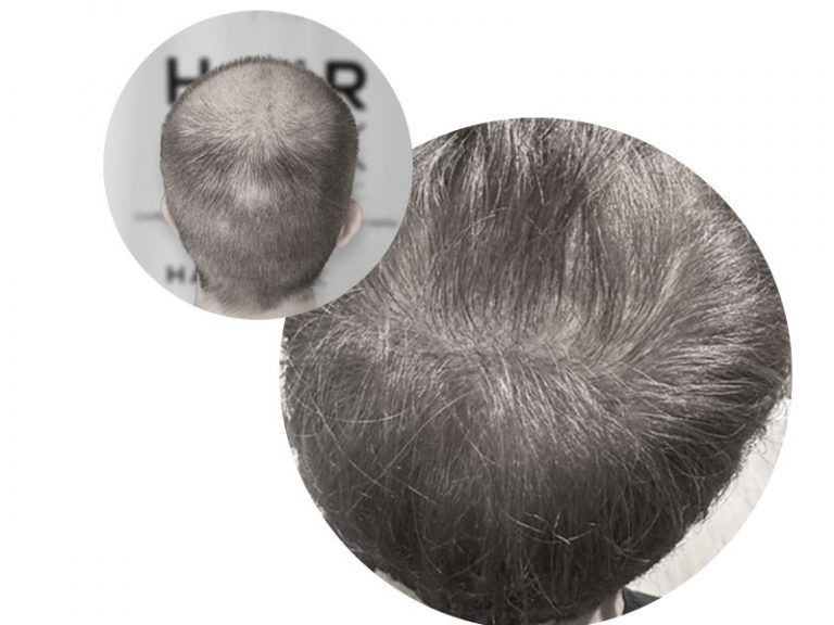 alopécie-vertex-Dr-Baykal-Oymak-Greffe-Cheveux