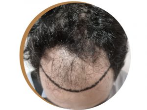 pré-opératoire turquie greffe cheveux baykal oymak